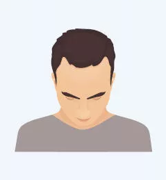 Haaransatz-Korrektur