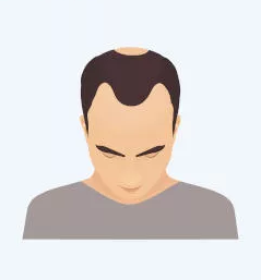 Scheitel- und Kronenauffüllung