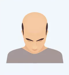 Vollständige Glatzenpigmentierung