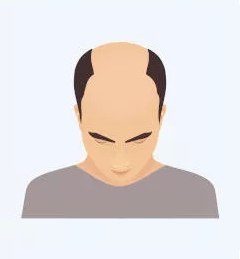 Umfassende Kopfhautpigmentierung